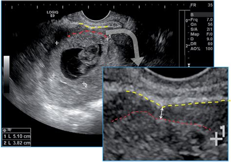 measurement of lower uterine segment thickness|myometrium thickness.